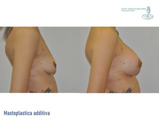 Mastoplastica additiva - Dott. Sergio Delfino
