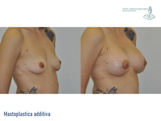 Mastoplastica additiva - Dott. Sergio Delfino