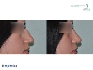 Rinoplastica - Dott. Sergio Delfino