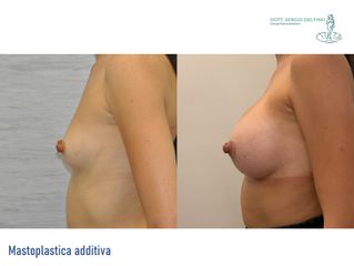 Mastoplastica additiva - Dott. Sergio Delfino