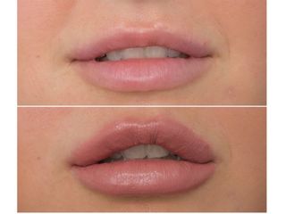 Filler labbra prima e dopo