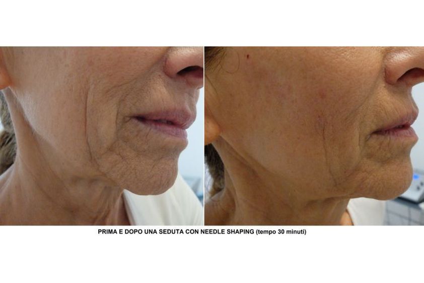 Needling prima e dopo - 790981