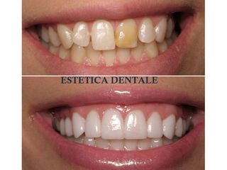 Sbiancamento denti - Dott. Denis Spagnolo