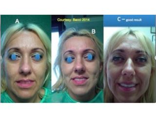 Rinoplastica prima e dopo