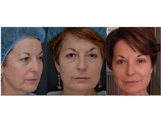 Blefaroplastica prima e dopo