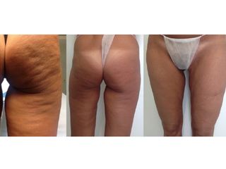 Cellulite prima e dopo