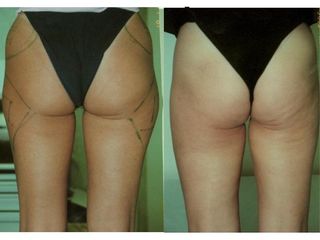 Liposcultura e fili prima e dopo