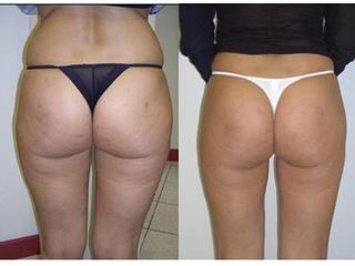 Liposcultura prima e dopo