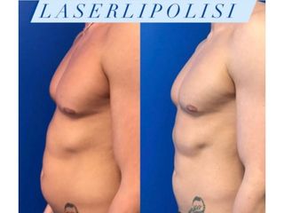 laserlipolisis - Dott. Bellone Donato