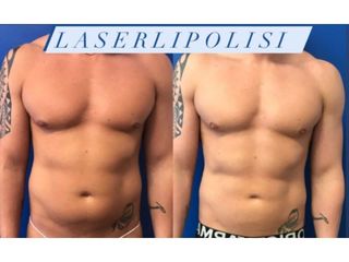 laserlipolisis - Dott. Bellone Donato