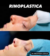 Rinoplastica - Dott. Bellone Donato