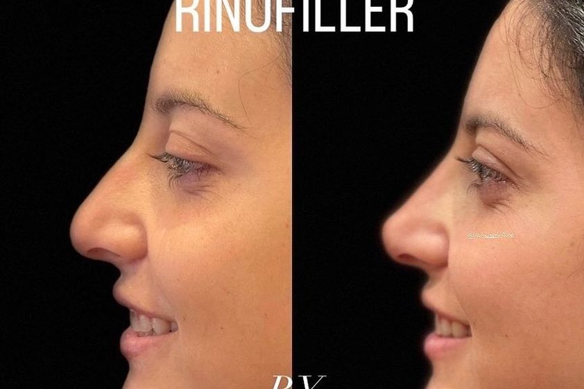 Rinofiller prima e dopo - 857562