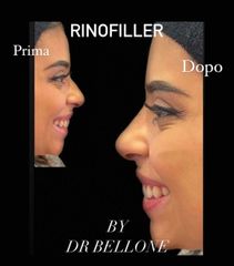 Rinofiller - Dott. Bellone Donato
