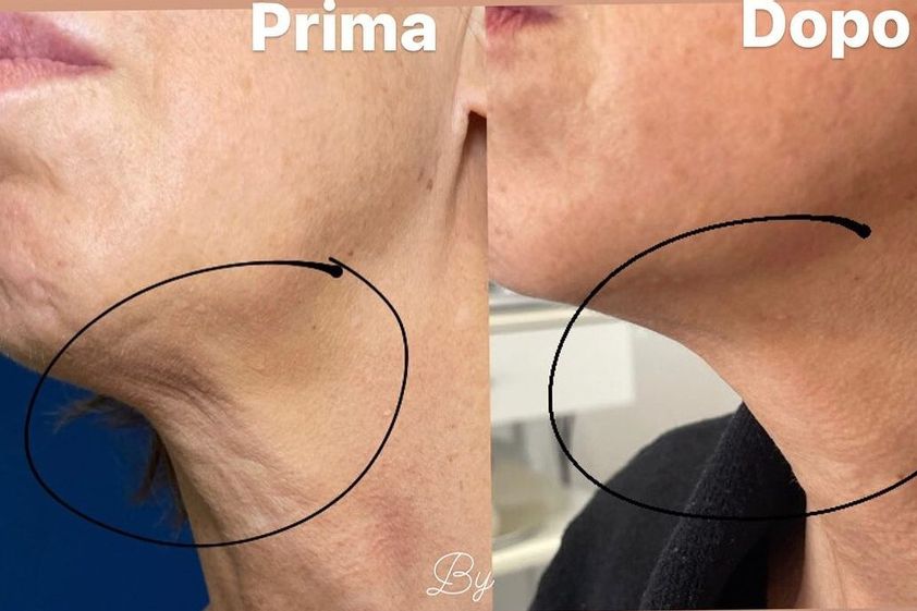 Ringiovanimento prima e dopo - 864279