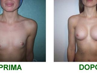 mastoplastica additiva prima dopo