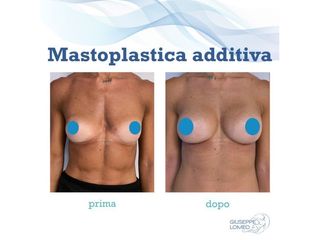 Mastoplastica additiva prima e dopo