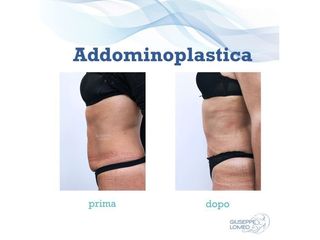 Addominoplastica prima e dopo