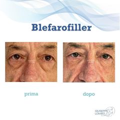 Blefaroplastica - Dott. Giuseppe Lomeo