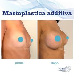 Mastoplastica additiva - Dott. Giuseppe Lomeo