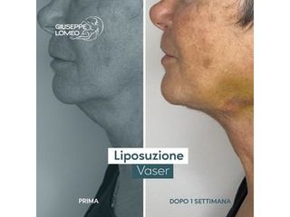 Liposuzione - Dott. Giuseppe Lomeo