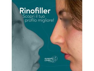 Rinofiller - Dott. Giuseppe Lomeo