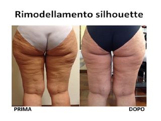 Liposuzione prima e dopo