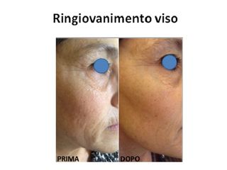 Ringiovanimento viso prima e dopo