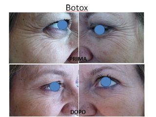 Botox prima e dopo