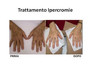 Ipercromie prima e dopo