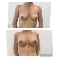 Mastoplastica additiva - Dott.ssa Cinzia Sisti