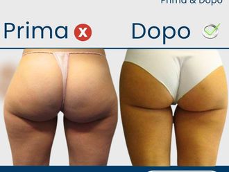 Liposuzione prima e dopo - 879497