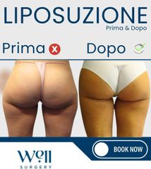 Well Surgery Liposuzione
