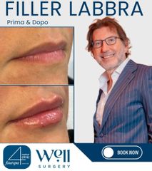 Well Surgery Filler Labbra