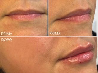 Filler labbra prima e dopo - 879501
