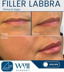 Well Surgery Filler Labbra