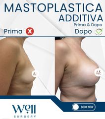 Well Surgery Mastoplastica additiva