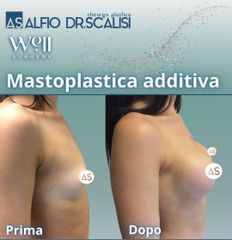 Well Surgery Mastoplastica additiva