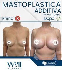 Well Surgery Mastoplastica additiva