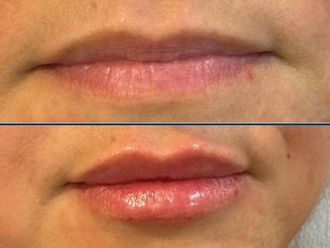 Filler labbra prima e dopo - 879505