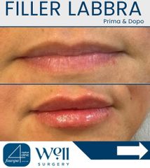 Well Surgery Filler Labbra