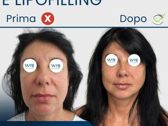 Lifting viso prima e dopo - 879506