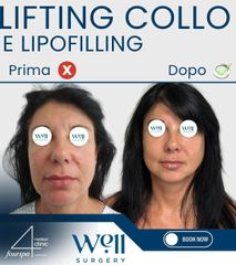 Well Surgery Lifting Collo e Lipofilling