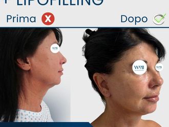 Lifting viso prima e dopo - 879508