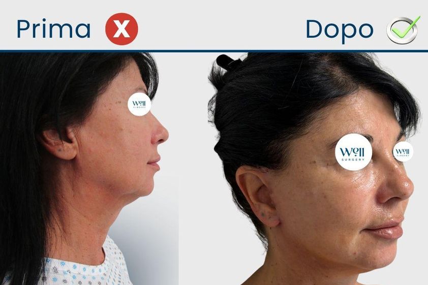 Lifting viso prima e dopo - 879508