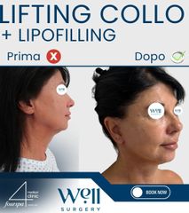 Well Surgery Lifting collo e Lipofilling