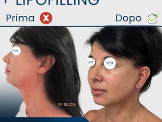 Lipofilling prima e dopo - 879607