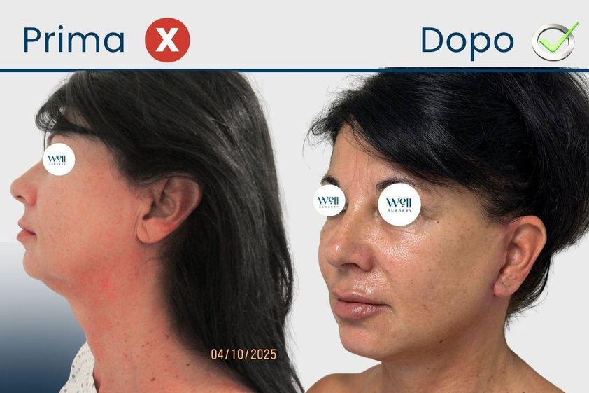 Lipofilling prima e dopo - 879607
