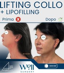 Well Surgery Lifting Collo + Lipofilling