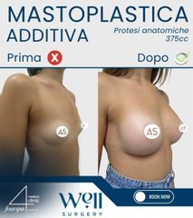 Well Surgery Mastoplastica Additiva