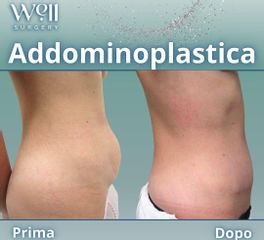 Well Surgery Addominoplastica